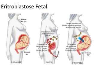 Eritroblastose Fetal
 
