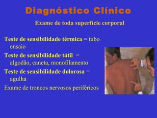 Diagnóstico Clínico
Exame de toda superfície corporal
Teste de sensibilidade térmica = tubo
ensaio
Teste de sensibilidade tátil =
algodão, caneta, monofilamento
Teste de sensibilidade dolorosa =
agulha
Exame de troncos nervosos periféricos
 