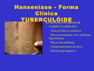 Hanseníase - Forma
Clínica
TUBERCULÓIDEHANSENÍASE PAUCIBACILAR
• TUBERCULOIDE (HT)
Áreas de hipo ou anestesia
Placas eritematosas e/ou eritêmato-
hipocrômicas
Placas bem definidas
Comprometimento de nervo
Baciloscopia negativa
 