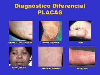 Diagnóstico Diferencial
PLACAS
GRANULOMA ANULAR LUPUS VULGAR MHT
SARCOIDOSE TINEA CORPORIS PSORÍASE
 