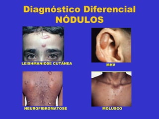 Diagnóstico Diferencial
NÓDULOS
LEISHMANIOSE CUTÂNEA MHV
NEUROFIBROMATOSE MOLUSCO
 
