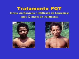 Tratamento PQT
forma virchowiana e infiltrada da hanseníase
após 12 meses de tratamento
 