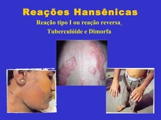 Reações Hansênicas
Reação tipo I ou reação reversa
Tuberculóide e Dimorfa
 