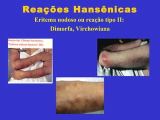 Reações Hansênicas
Eritema nodoso ou reação tipo II:
Dimorfa, Virchowiana
 