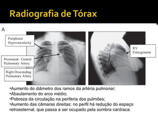Aumento do diâmetro dos ramos da artéria pulmonar; Abaulamento do arco médio; Pobreza da circulação na periferia dos pulmões; Aumento das câmaras direitas: no perfil há redução do espaço  retroesternal, que passa a ser ocupado pela sombra cardíaca . 