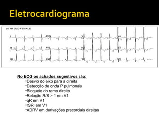 No ECG os achados sugestivos são: Desvio do eixo para a direita Detecção de onda P pulmonale Bloqueio do ramo direito Relação R/S > 1 em V1 qR em V1 rSR‘ em V1 ADRV em derivações precordiais direitas 