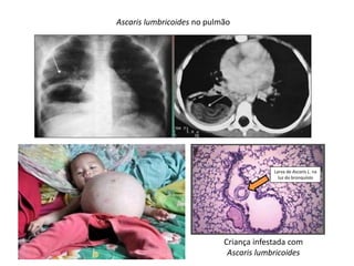 Ascaris lumbricoides no pulmão
Criança infestada com
Ascaris lumbricoides
Larva de Ascaris L. na
luz do bronquíolo
 