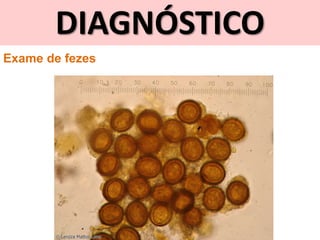 DIAGNÓSTICO
Exame de fezes
 