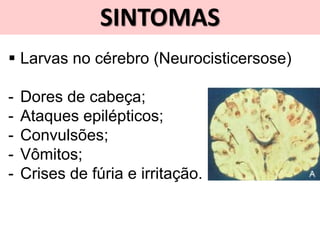 SINTOMAS
 Larvas no cérebro (Neurocisticersose)
- Dores de cabeça;
- Ataques epilépticos;
- Convulsões;
- Vômitos;
- Crises de fúria e irritação.
 