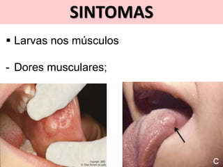 SINTOMAS
 Larvas nos músculos
- Dores musculares;
 