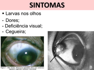 SINTOMAS
 Larvas nos olhos
- Dores;
- Deficiência visual;
- Cegueira;
 