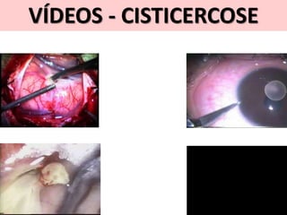 VÍDEOS - CISTICERCOSE
 