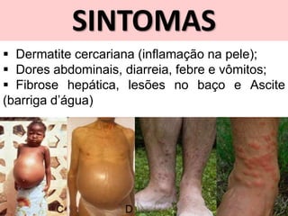 SINTOMAS
 Dermatite cercariana (inflamação na pele);
 Dores abdominais, diarreia, febre e vômitos;
 Fibrose hepática, lesões no baço e Ascite
(barriga d’água)
 
