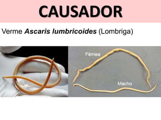 CAUSADOR
Verme Ascaris lumbricoides (Lombriga)
 
