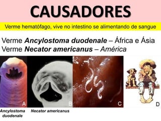 CAUSADORES
Verme Ancylostoma duodenale – África e Ásia
Verme Necator americanus – América
Ancylostoma
duodenale
Necator americanus
Verme hematófago, vive no intestino se alimentando de sangue
 