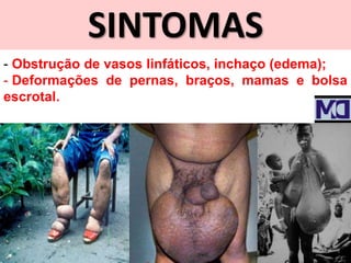 SINTOMAS
- Obstrução de vasos linfáticos, inchaço (edema);
- Deformações de pernas, braços, mamas e bolsa
escrotal.
 