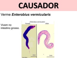 CAUSADOR
Verme Enterobius vermicularis
Vivem no
intestino grosso.
 