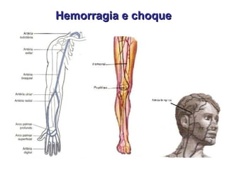 Hemorragia e choque 