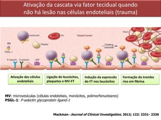 Ativação da cascata via fator tecidual quando
não há lesão nas células endoteliais (trauma)
Mackman -Journal of Clinical Investigation, 2012; 122: 2331- 2336
Ativação das células
endoteliais
Ligação de leucócitos,
plaquetas e MV-FT
Indução da expressão
do FT nos leucócitos
Formação do trombo
rico em fibrina
MV
MV: microvesículas (células endoteliais, monócitos, polimorfonucleares)
PSGL-1: P-selectin glycoprotein ligand-1
 