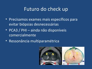 Futuro do check up
• Precisamos exames mais específicos para
evitar biópsias desnecessárias
• PCA3 / PHI – ainda não disponíveis
comercialmente
• Ressonância multiparamétrica

 
