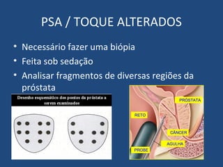 PSA / TOQUE ALTERADOS
• Necessário fazer uma biópia
• Feita sob sedação
• Analisar fragmentos de diversas regiões da
próstata

 