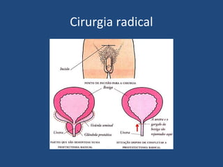 Cirurgia radical

 