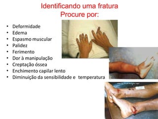 Identificando uma fratura
Procure por:
•
•
•
•
•
•
•
•
•
Deformidade
Edema
Espasmo muscular
Palidez
Ferimento
Dor à manipulação
Creptação óssea
Enchimento capilar lento
Diminuição da sensibilidade e temperatura
 