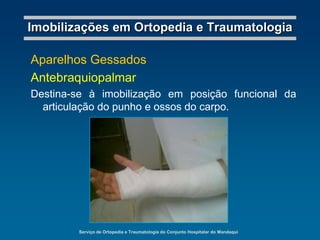 Serviço de Ortopedia e Traumatologia do Conjunto Hospitalar do MandaquiImobilizações em Ortopedia e TraumatologiaGoteiras Gessadas“Pinça de confeiteiro”Destina-se à imobilização do braço por ação da goteira e, ao mesmo tempo, através da tração exercida no braço pelo peso do gesso. Indicada nas fraturas do terço médio do úmero.