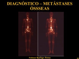 DIAGNÓSTICO – METÁSTASES ÓSSSEAS 