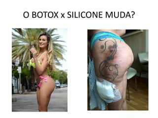 O BOTOX x SILICONE MUDA?
 