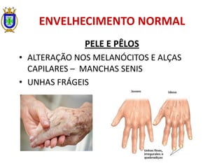 ENVELHECIMENTO NORMAL
PELE E PÊLOS
• ALTERAÇÃO NOS MELANÓCITOS E ALÇAS
CAPILARES – MANCHAS SENIS
• UNHAS FRÁGEIS
 