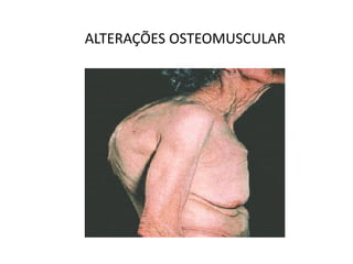 ALTERAÇÕES OSTEOMUSCULAR
 