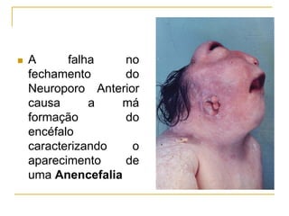  A falha no
fechamento do
Neuroporo Anterior
causa a má
formação do
encéfalo
caracterizando o
aparecimento de
uma Anencefalia
 