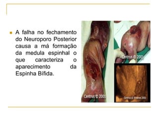  A falha no fechamento
do Neuroporo Posterior
causa a má formação
da medula espinhal o
que caracteriza o
aparecimento da
Espinha Bífida.
 