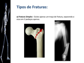Revisão das posições de Descrição Anatômica
• Posição Supina ou Decúbito Dorsal: o corpo está deitado com a face
voltada para cima.
 