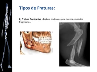 Revisão das posições de Descrição Anatômica
• Posição Prona ou Decúbito Ventral: o corpo está deitado com a face
voltada para baixo.
 