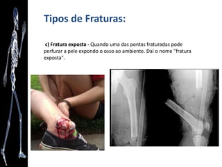 Revisão das posições de Descrição Anatômica
• Decúbito Lateral: o corpo está deitado de lado.
 