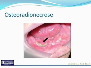 Osteoradionecrose
 