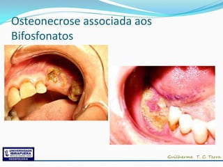 Osteonecrose associada aos
Bifosfonatos
 