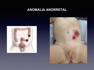 ANOMALIA ANORRETAL
 