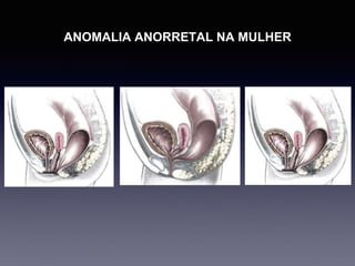 ANOMALIA ANORRETAL NA MULHER
 