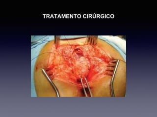 TRATAMENTO CIRÚRGICO
 