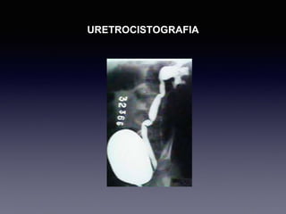 URETROCISTOGRAFIA
 