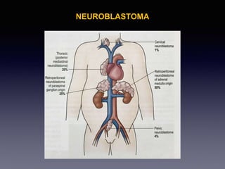 NEUROBLASTOMA
 