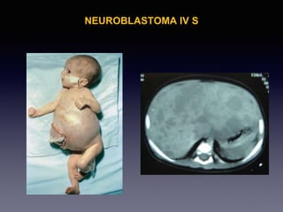 NEUROBLASTOMA IV S
 
