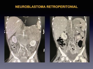 NEUROBLASTOMA RETROPERITONIAL
 