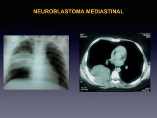 NEUROBLASTOMA MEDIASTINAL
 