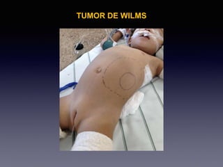 TUMOR DE WILMS
 