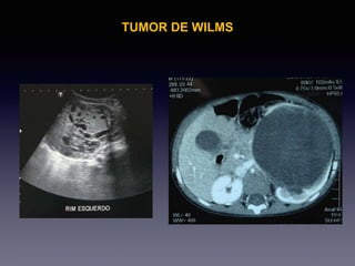 TUMOR DE WILMS
 