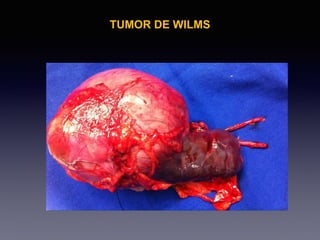 TUMOR DE WILMS
 